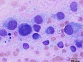 Chondrosarcoma