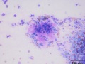 Chondrosarcoma