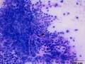 Chondrosarcoma