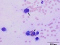 Chondrosarcoma