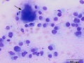 Chondrosarcoma (osteoclast)