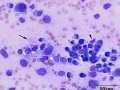 Chondrosarcoma