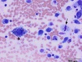 Chondrosarcoma