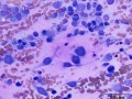 Chondrosarcoma