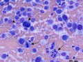 Chondrosarcoma (necrosis, mitoses)