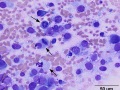 Chondrosarcoma (mitoses)
