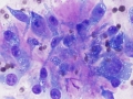 Osteosarcoma (humerus)
