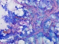 Mast cell tumor with collagen