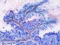 Mast cell tumor with blood vessels