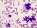Amyloid