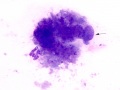 Amyloid
