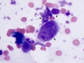 Extramedullary plasmacytoma & amyloid