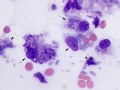 Amyloid
