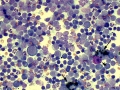 Melanophages (LN)