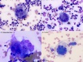Multinucleated giant cell compilation