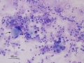 Mixed inflammation with keratin