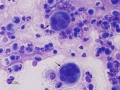 Mixed inflammation
