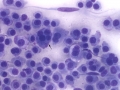 Extramedullary plasmacytoma (DQ, dog)