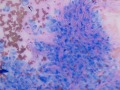 Soft tissue sarcoma