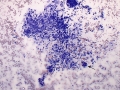 Soft tissue sarcoma
