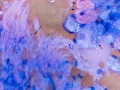 Soft tissue sarcoma