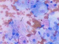 Soft tissue sarcoma