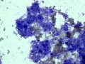 Calcinosis circumscripta