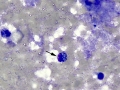 Calcinosis circumscripta