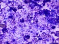 Calcinosis circumscripta
