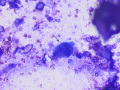 Calcinosis circumscripta