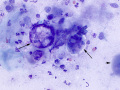 Emperipolesis in squames