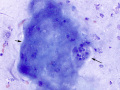 Emperipolesis & keratinaceous debris