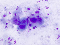 Emperipolesis in squames (rapid stain)