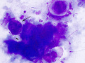 Degenerating squames (rapid stain)