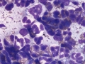 Eosinophilic inflammation