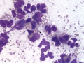 Eosinophilic inflammation