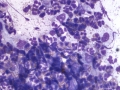 Eosinophilic inflammation