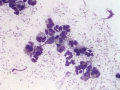 Eosinophilic inflammation