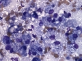 Granulomatous inflammation