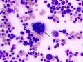 Blastomyces (WG)
