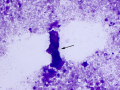 Suspect flame figure (rapid stain)