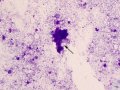 Suspect flame figure (rapid stain)