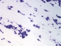 Granular cell trichoblastoma