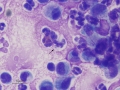 Mixed inflammation with bacteria