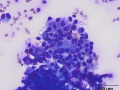 Granulomatous inflammation & keratin