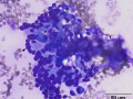 Granulomatous inflammation & keratin
