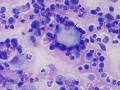 Mixed inflammation with keratin