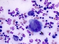 Langhans giant cell
