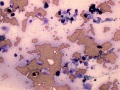 Melanoma