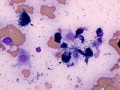 Melanoma